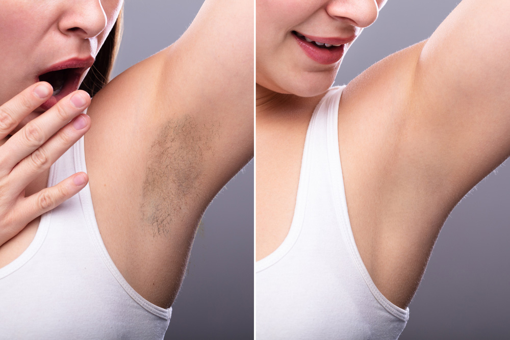 Laser Hair Removal Before and After